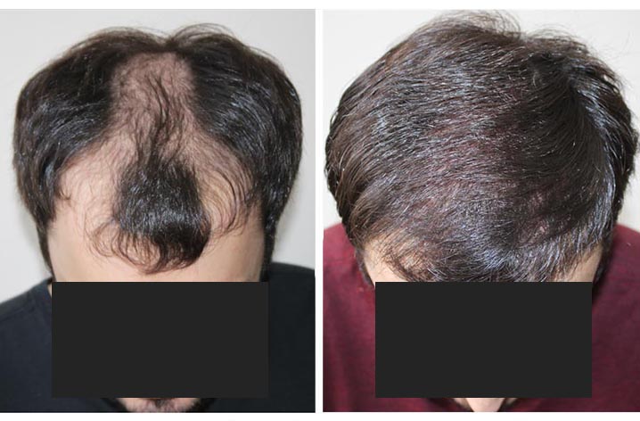 Методы пересадки волос