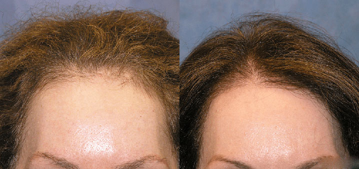 Пересадка волос до и после - фото - Клиника Heva